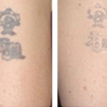 odstraňování tetování